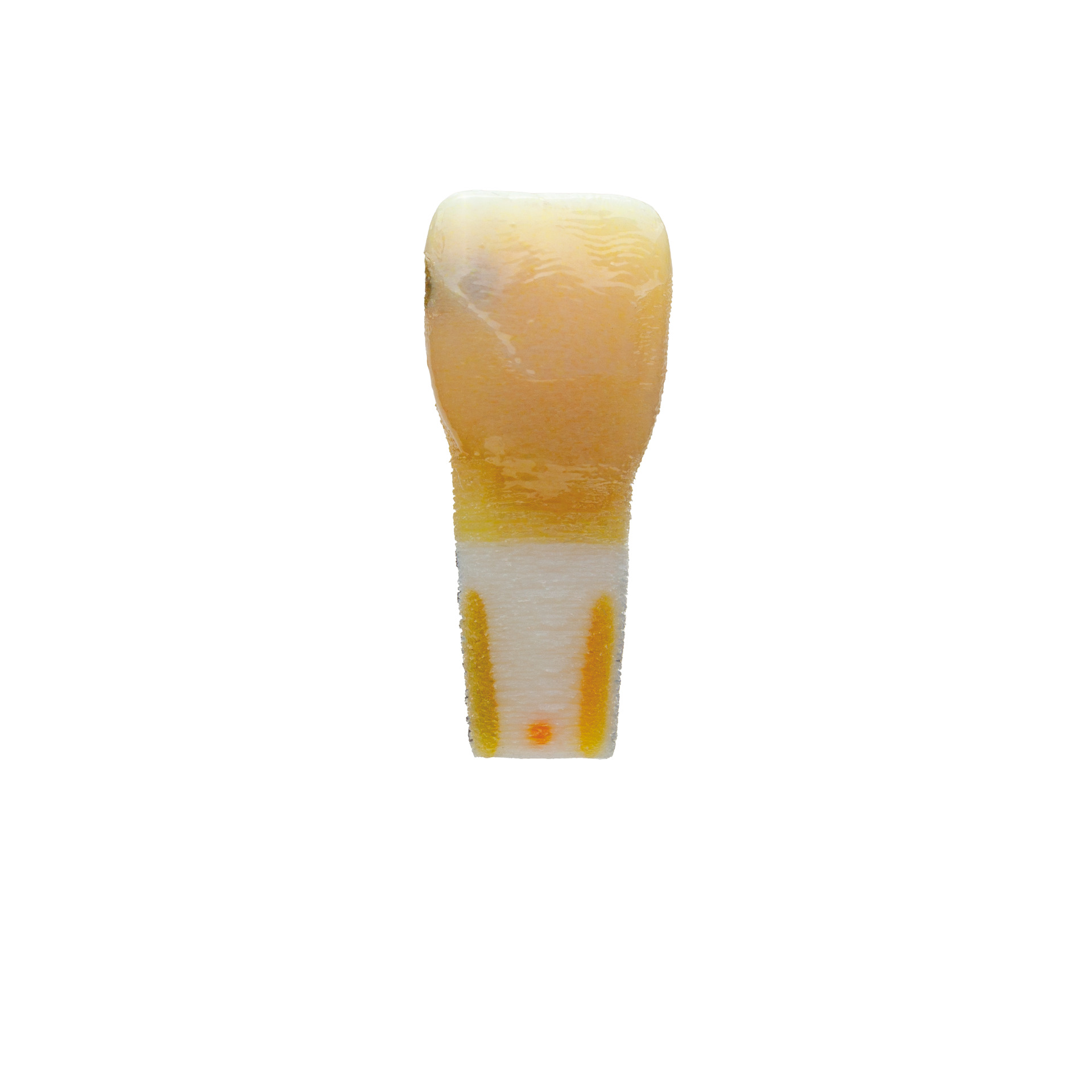 myteeth Practice Tooth 11 fully anatomical with mesial caries defect