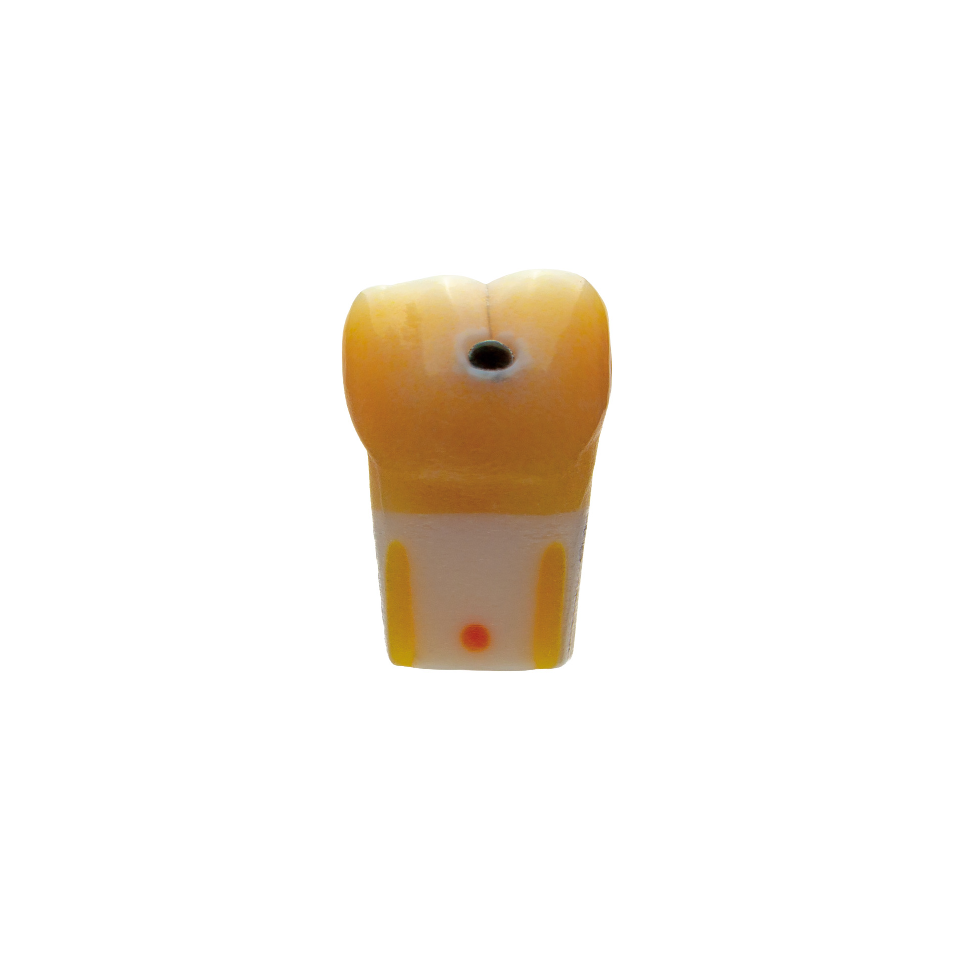 myteeth training tooth 46 mod, sufficient composite filling with fracture of the disto-lingual cusp Jaw model: ANA-4