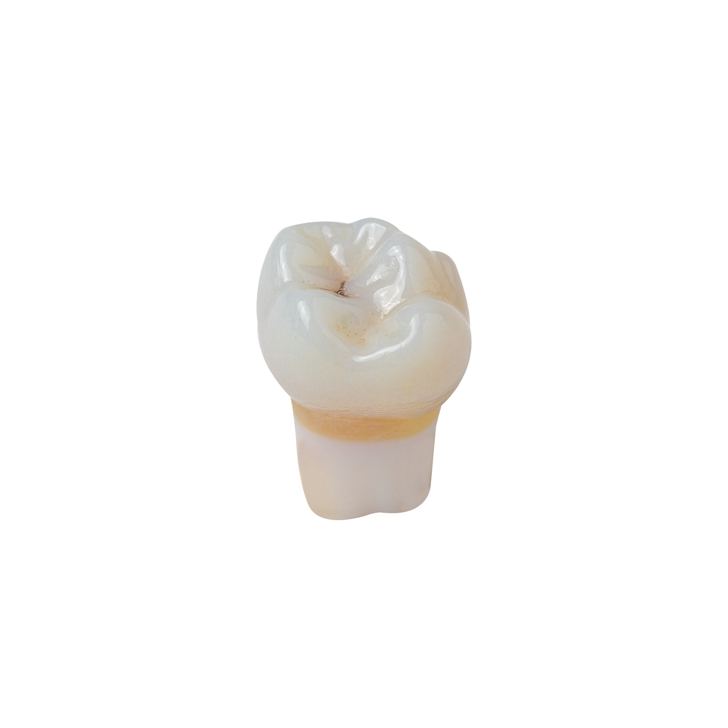 produkt 4d zahn ak 6 55mz okklusalkaries mit cp