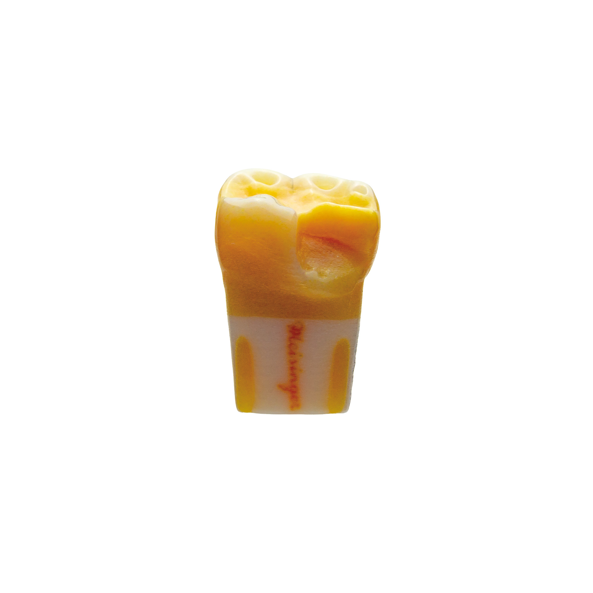 myteeth training tooth 46 mod, sufficient composite filling with fracture of the disto-lingual cusp Jaw model: ANKA-4