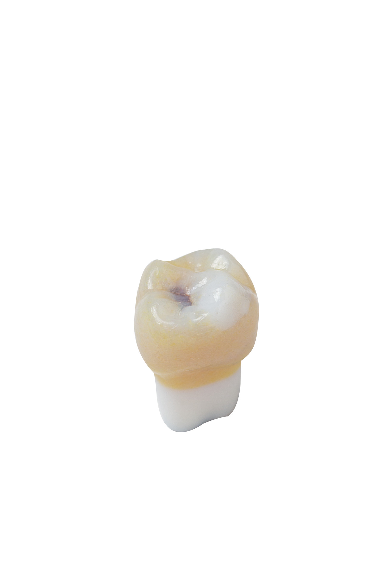 AK-6-2  26 6-year molar with typical appearance of a