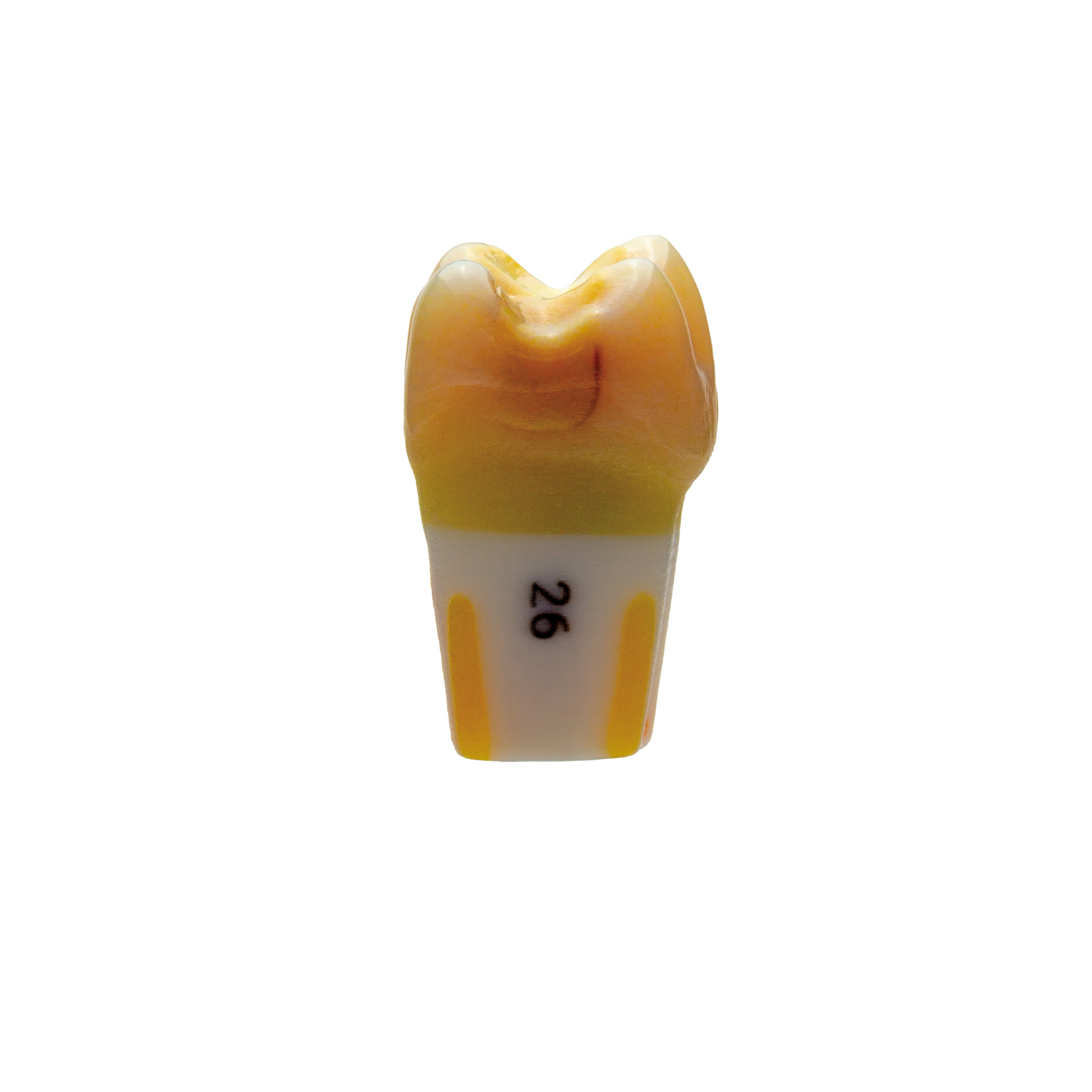 myteeth training tooth 26, insufficient filling od and approximal caries mesial with root filling