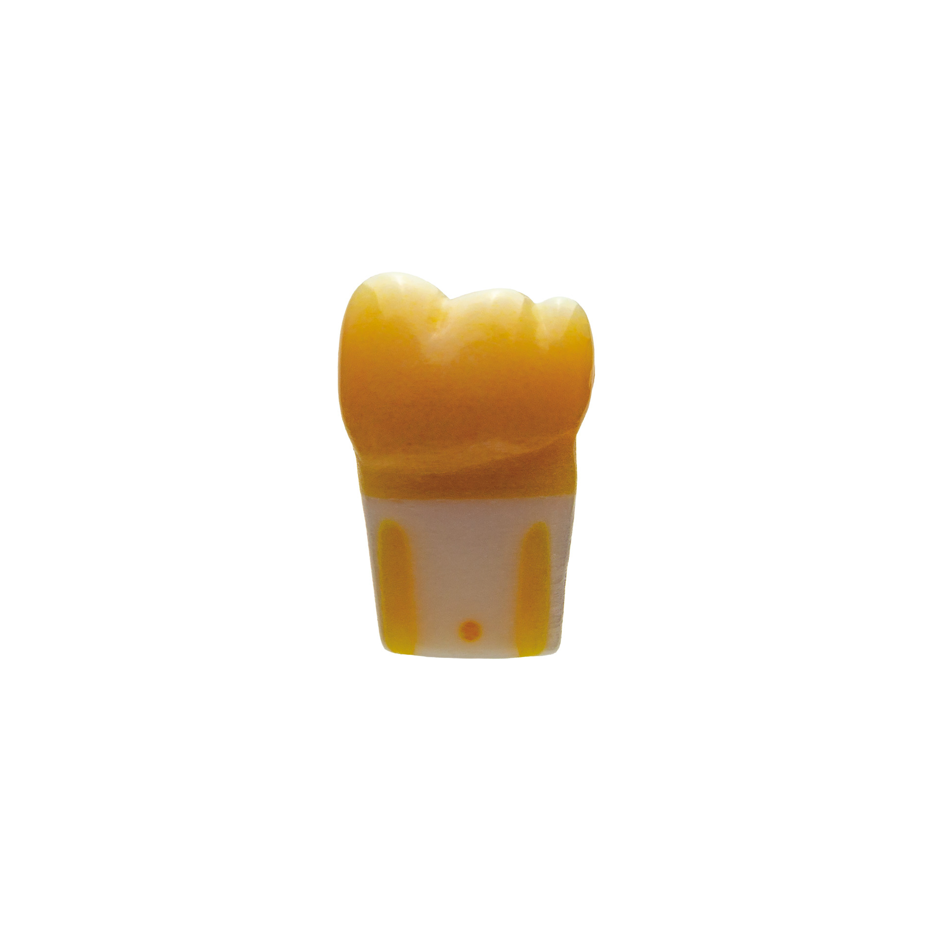 myteeth training tooth 36, fissure caries in central fissure Jaw model: ANA-4