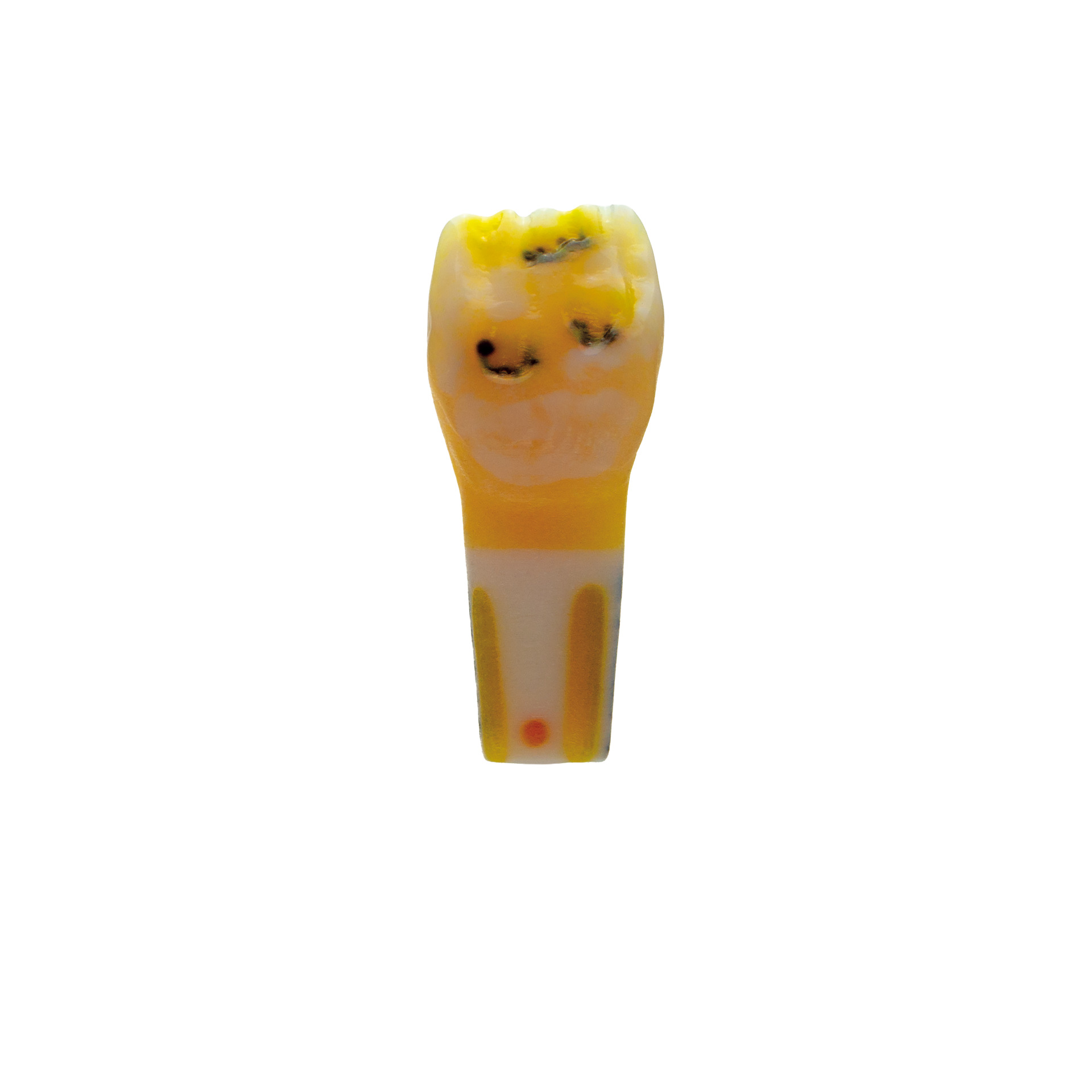 myteeth training tooth 21, amelogenesis imperfecta