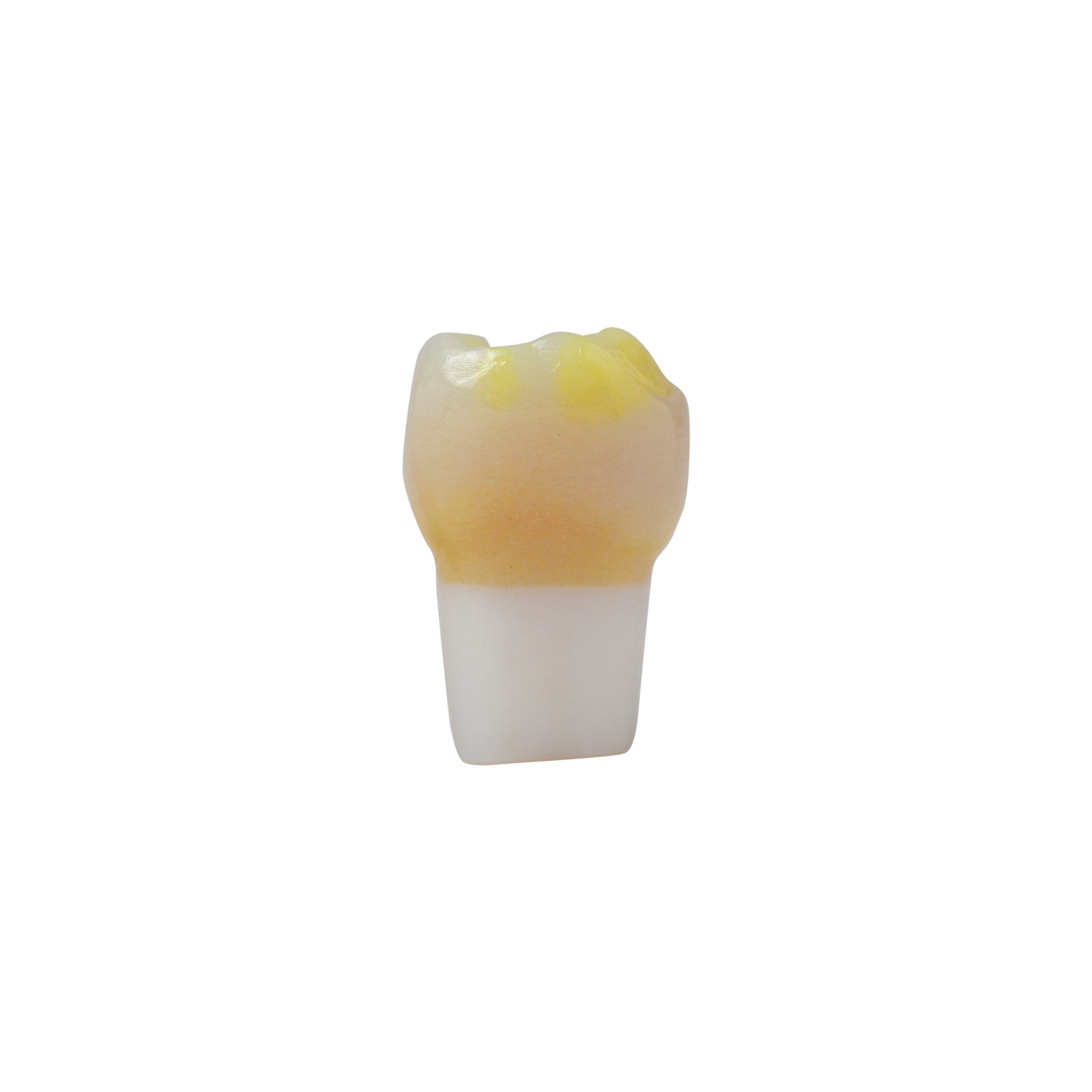 produkt 4d zahn ak 6 2 6 jahres molar 26 mit typischem erscheinungsbild einer ausgepraegten mih