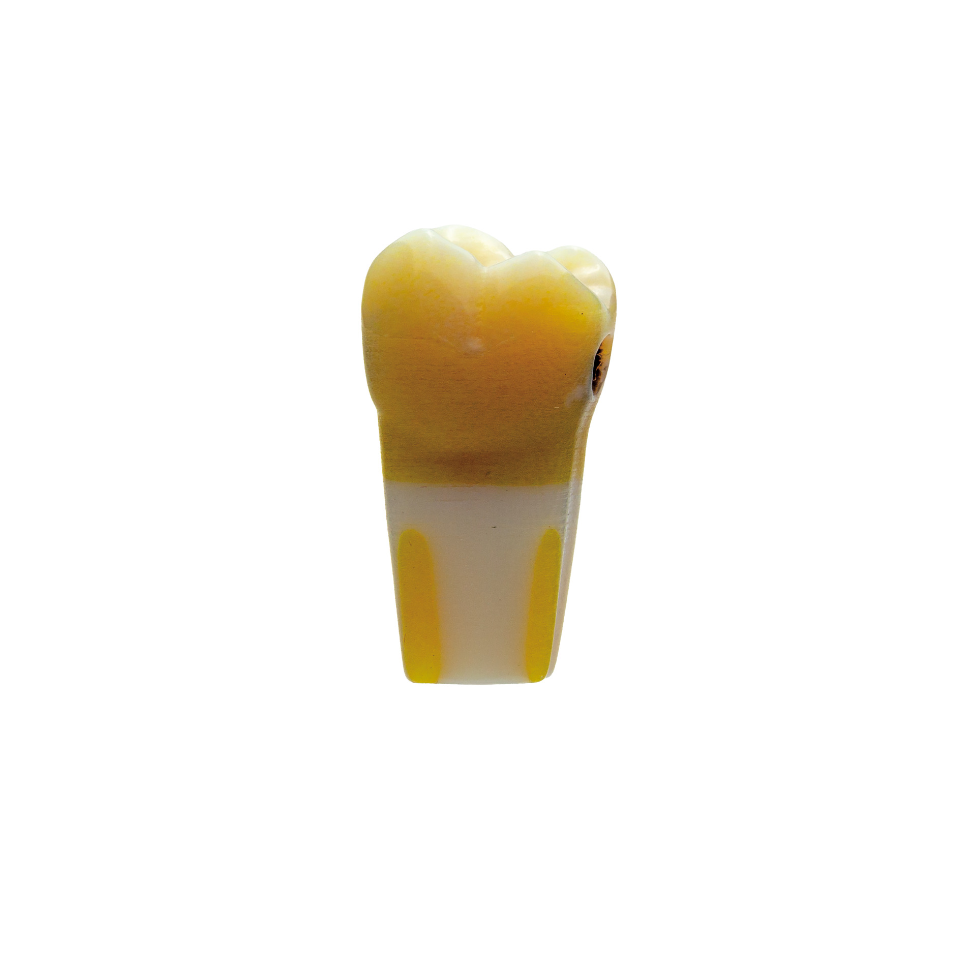 ANA-4 16 Molar mit Approximalkaries D3d-D4m