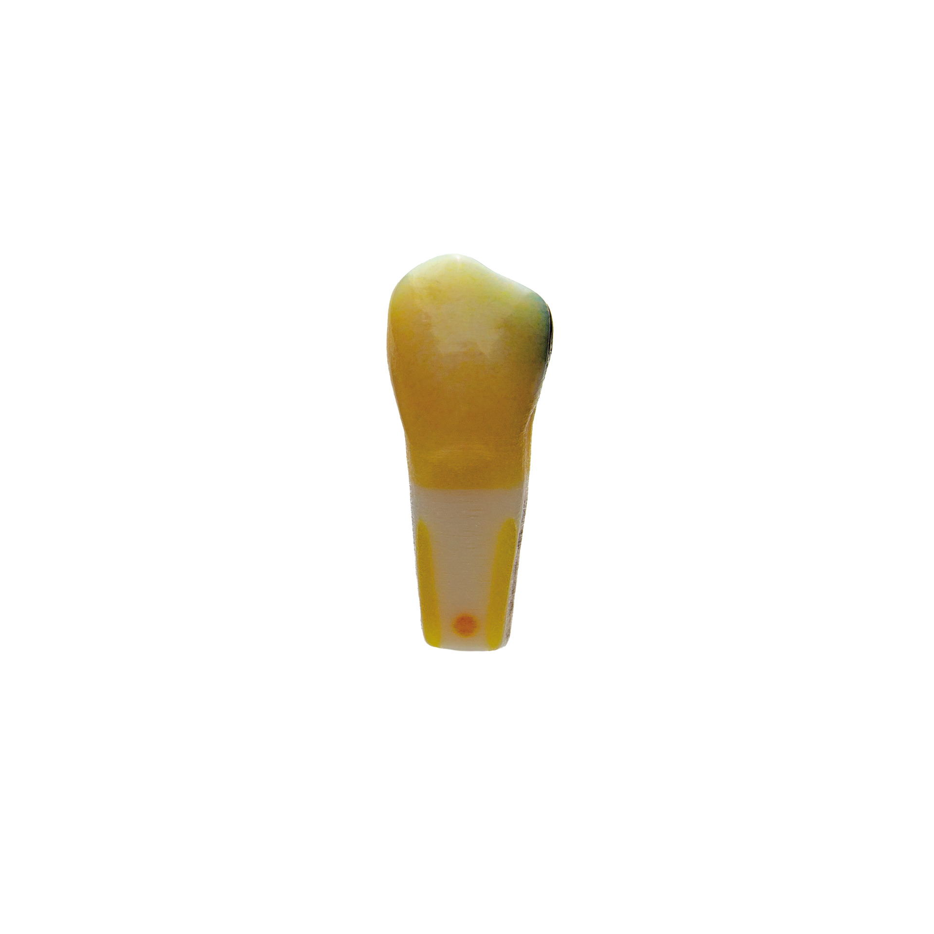 myteeth training tooth 35, od, insufficient amalgam filling with secondary caries distal Jaw model: ANA-4