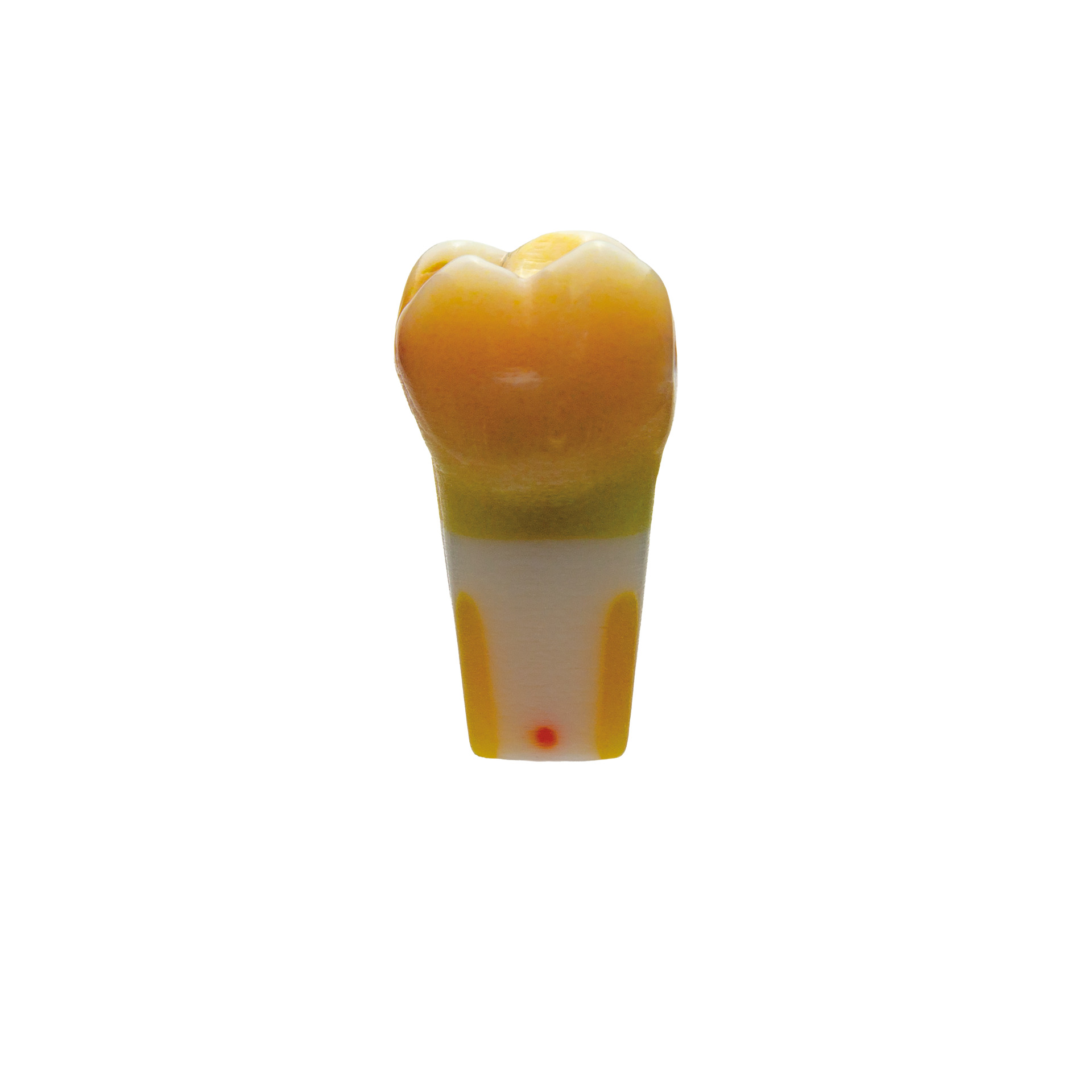 myteeth Übungszahn 26, insuffizienter Füllung od und Approximalkaries mesial mit Wurzelfüllung