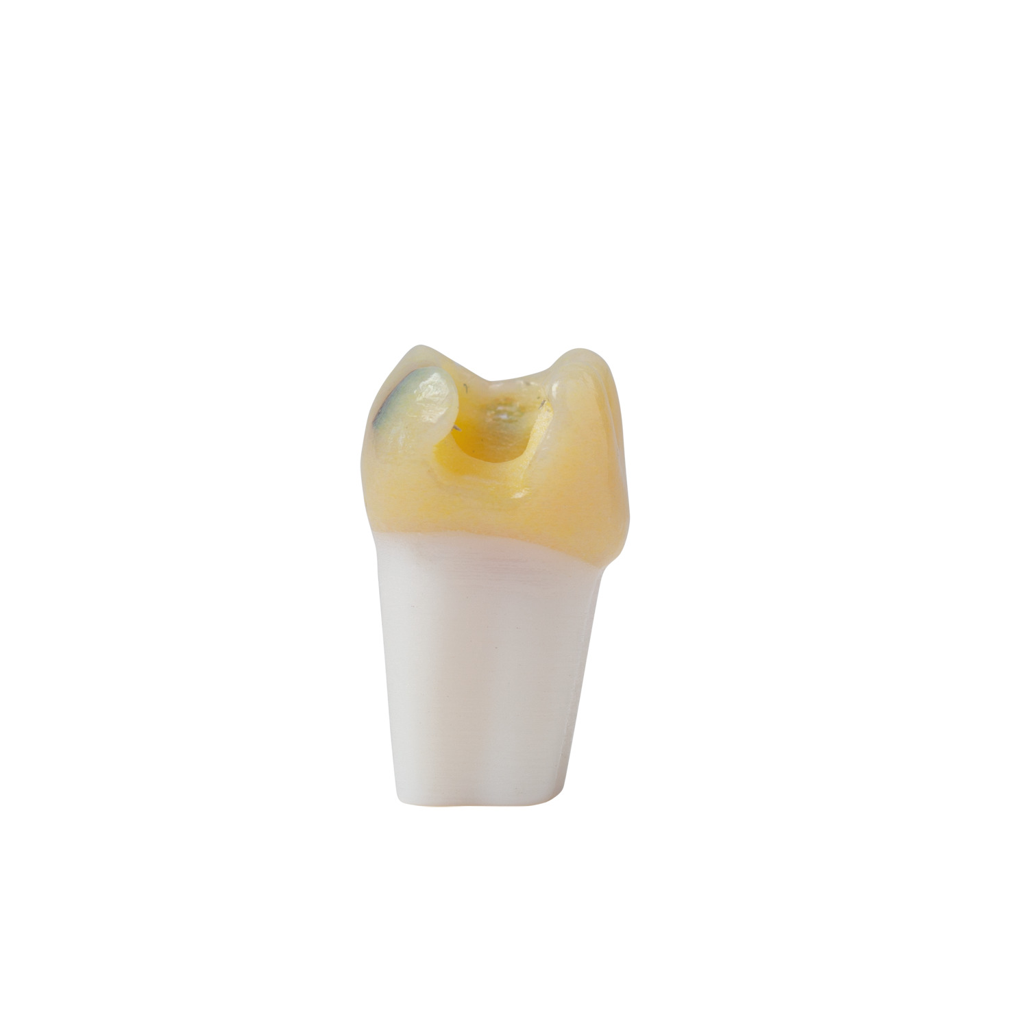 produkt 4d zahn ag 3 26 mit md inlay praeparation und kariesdefekt