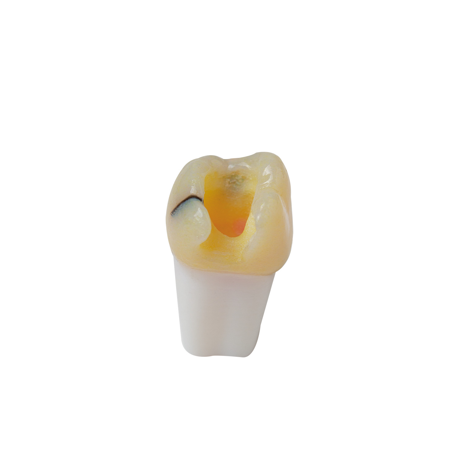 produkt 4d zahn ag 3 26 mit md inlay praeparation und kariesdefekt