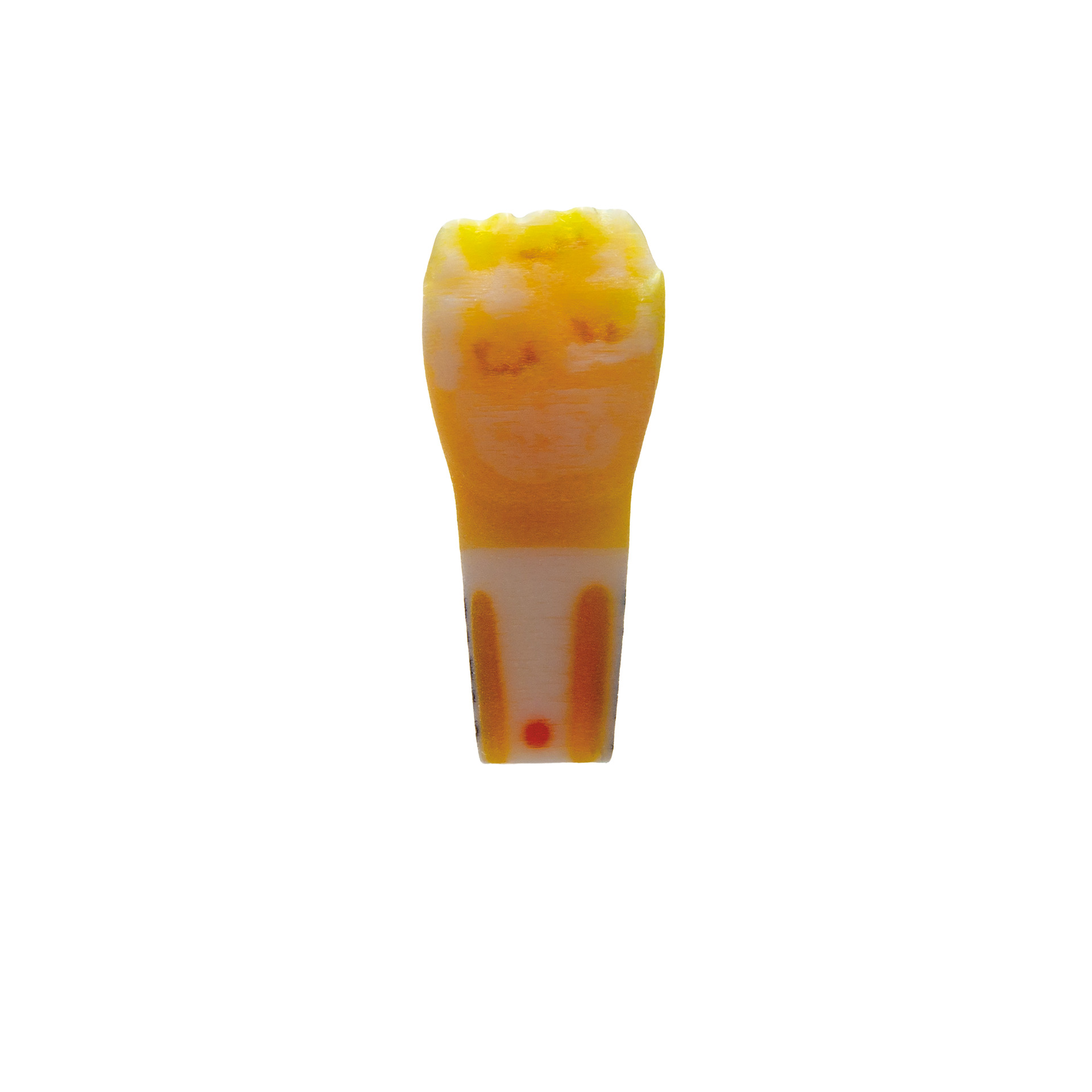 myteeth training tooth 21, mesial class III GIZ filling Filling+ Amelogenesis Imperfecta