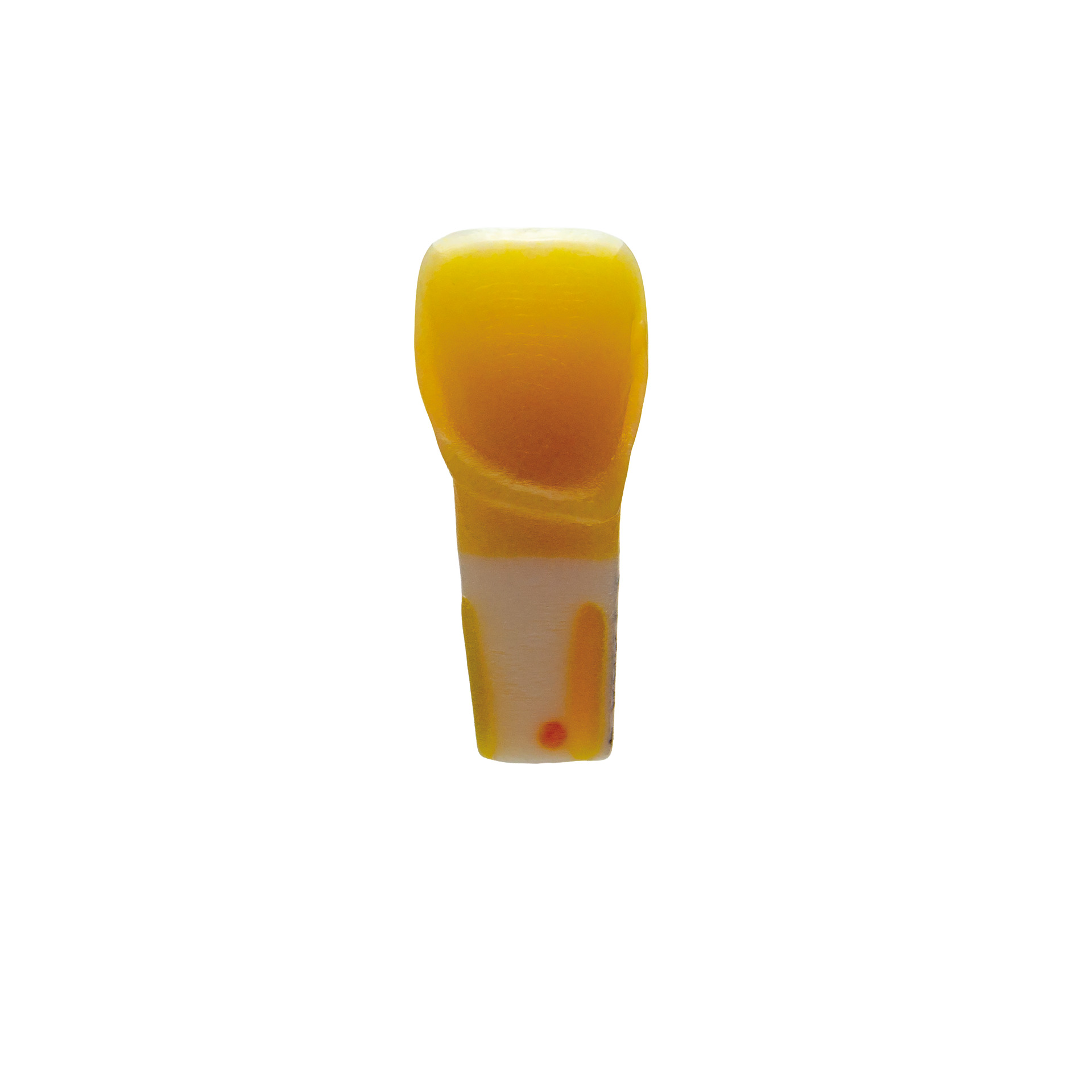 myteeth training tooth 11, with epigingival veneer preparation
