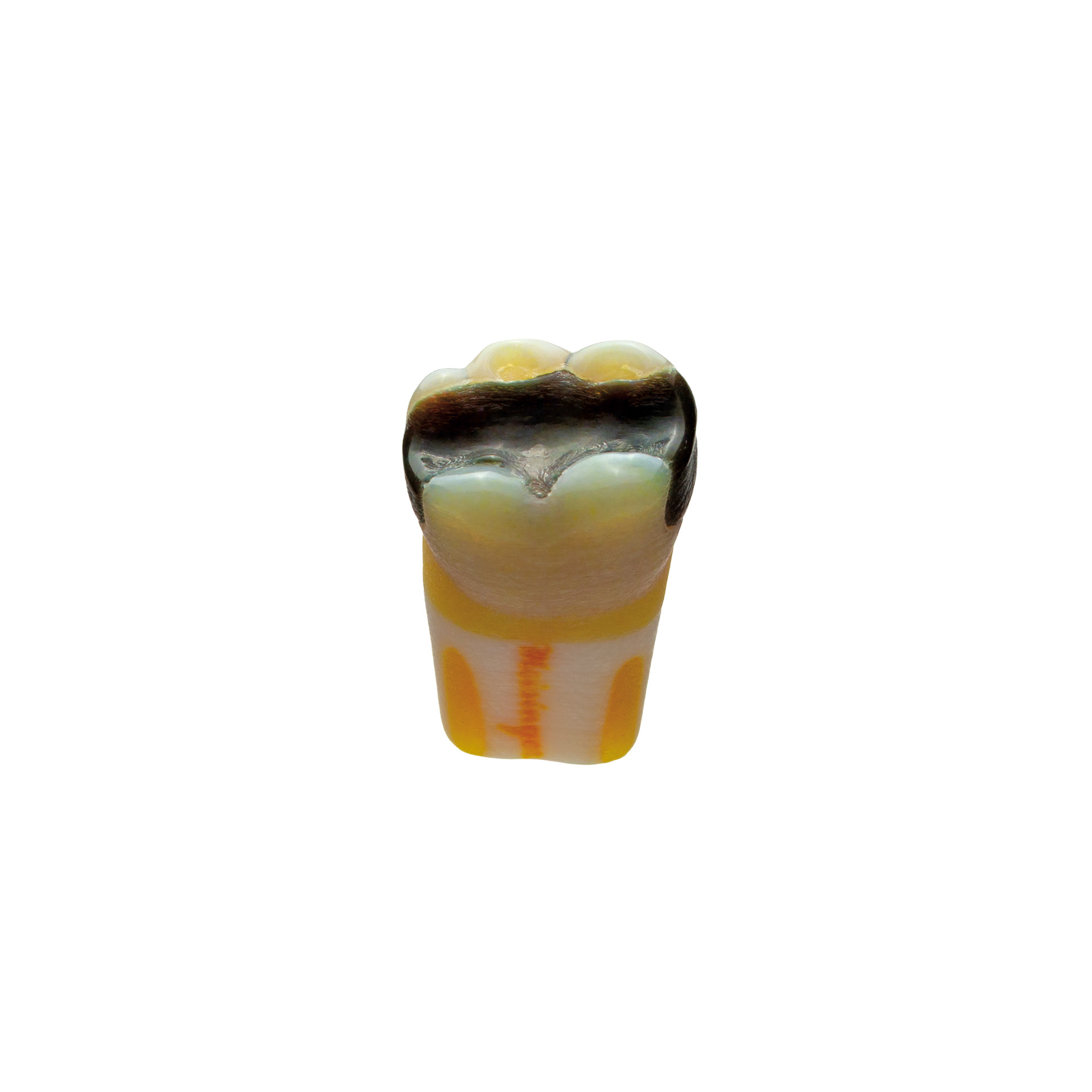 AG-3 36 with insufficient amalgam filling-mod