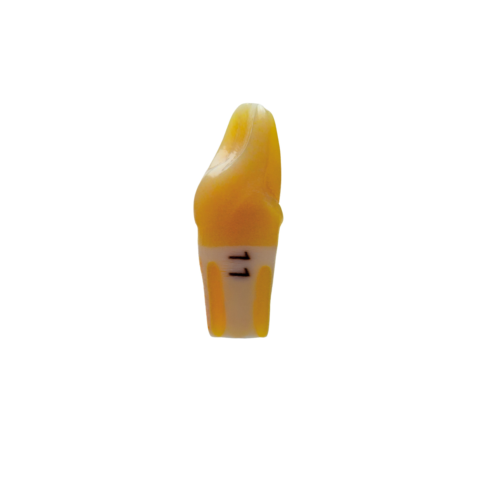 myteeth training tooth 11, with epigingival veneer preparation
