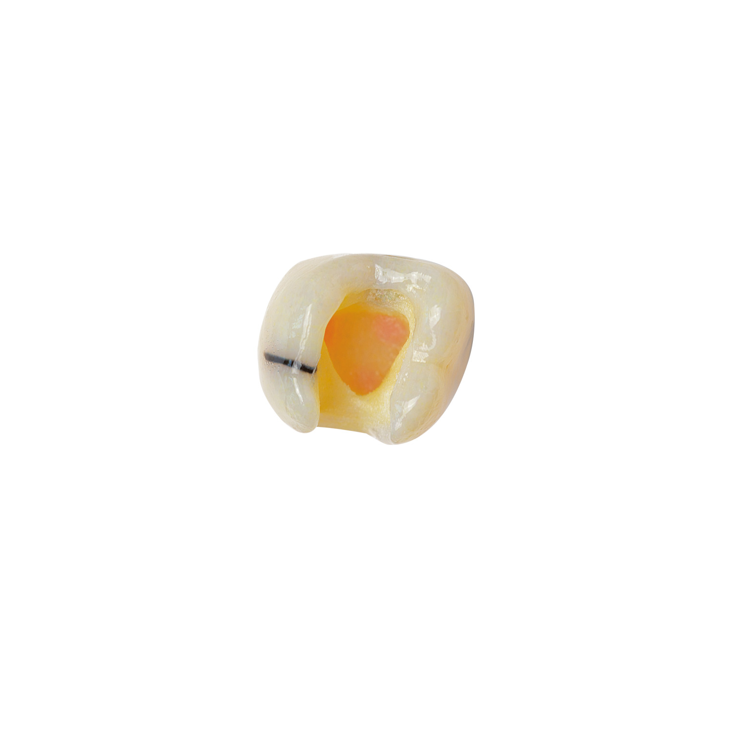 produkt 4d zahn ag 3 26 mit md inlay praeparation und kariesdefekt
