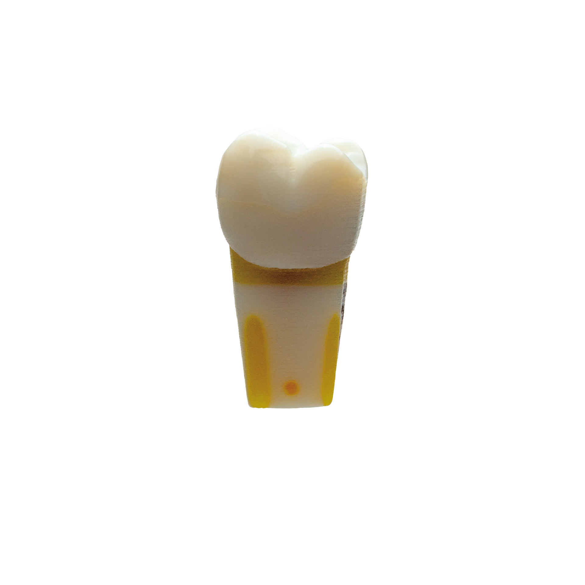 myteeth training tooth 16, insuff. Crown and secondary caries mesial
