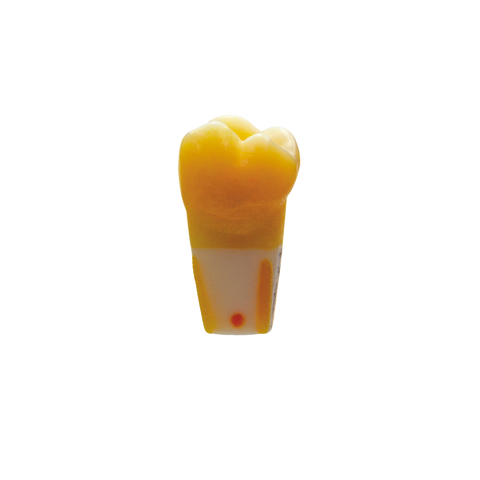 myteeth training tooth 17, with MO inlay preparation