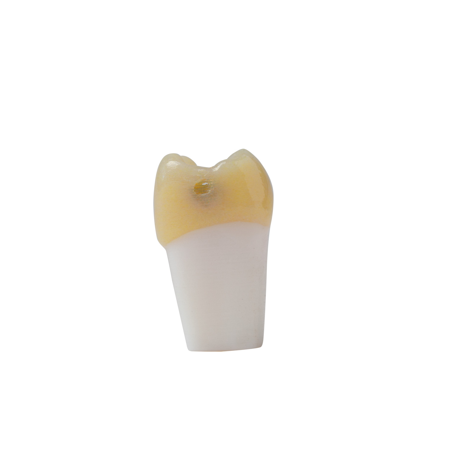 produkt 4d zahn ag 3 26 mit md inlay praeparation und kariesdefekt