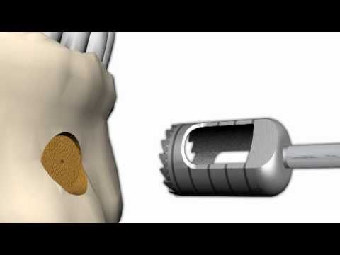 Transfer-Ring-Control I  (Horizontale und Vertikale Knochenring-Transplantation), CTRI0