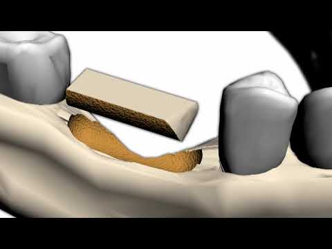 Transfer-Control Basic 2 (Horizontale und Vertikale Knochenblock-Transplantation), CTRB2