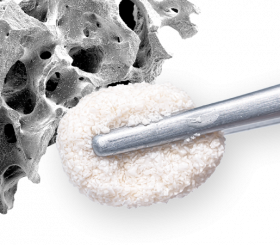 Bone replacement material